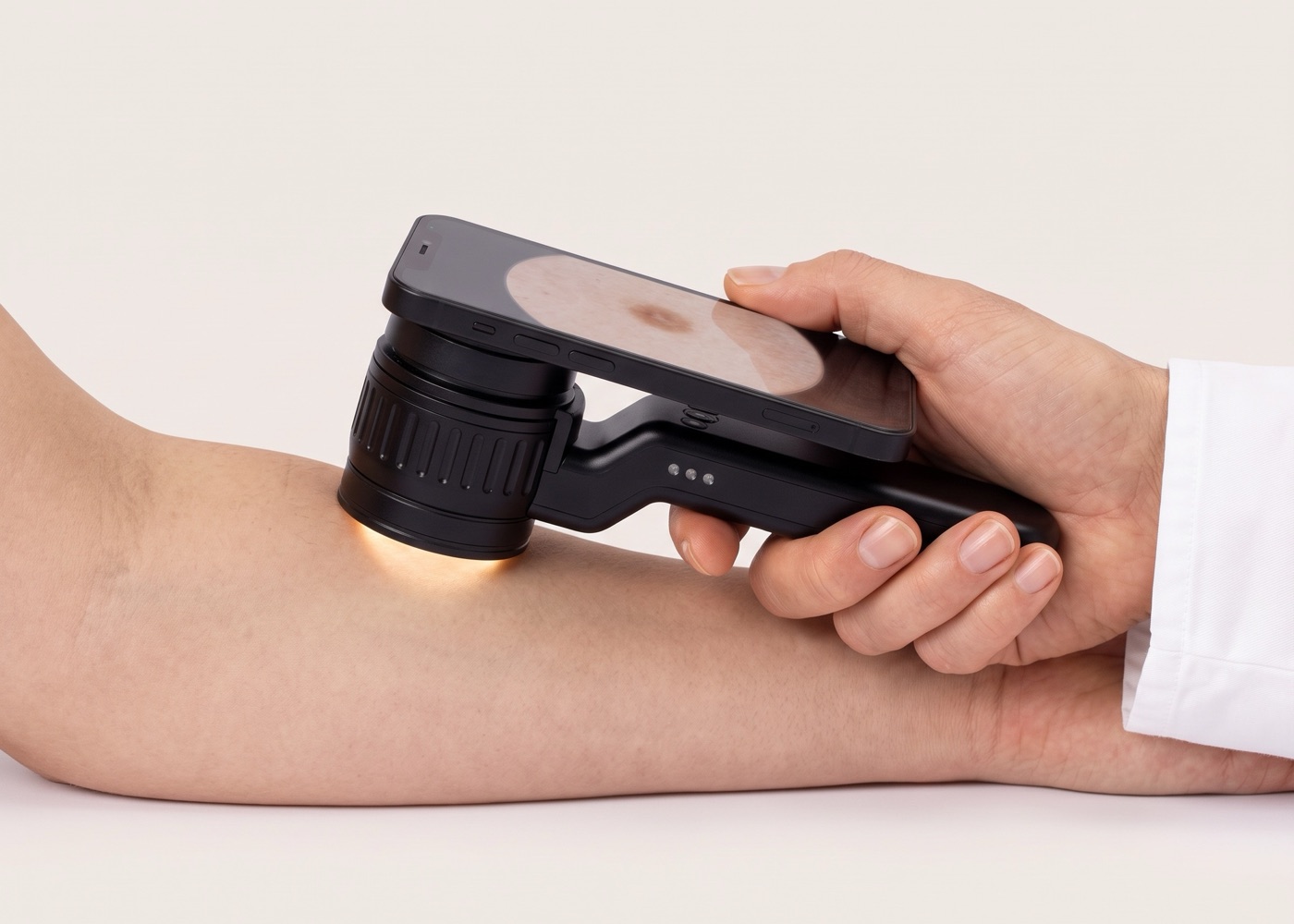 Eine Hand im weißen Kittel setzt ein Dermatoskop mit aufgestecktem Smartphone auf einen Unterarm, auf dem Bildschirm ist ein Muttermal vergrößert zu sehen