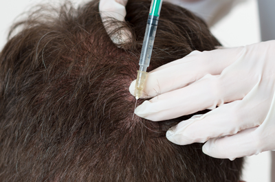 Mesotherapie für eine volle Haarpracht