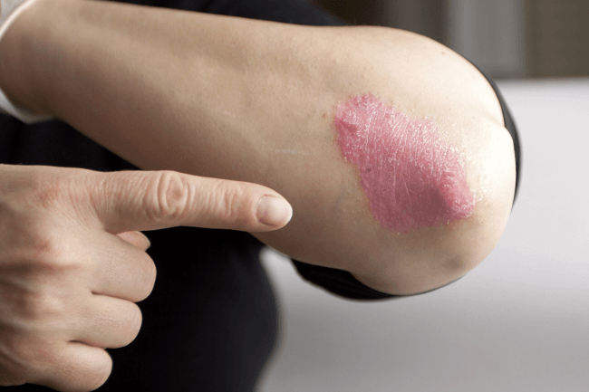 Behandlung von Psoriasis